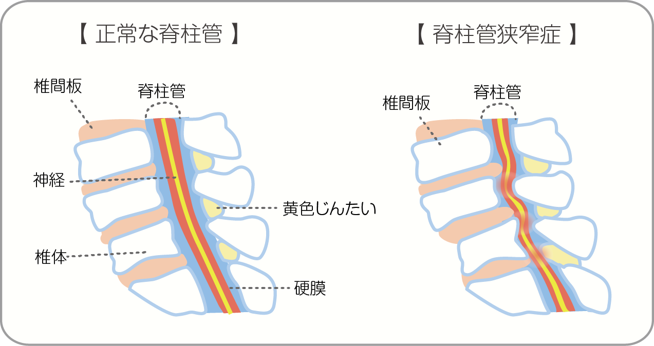 脊柱管狭窄症