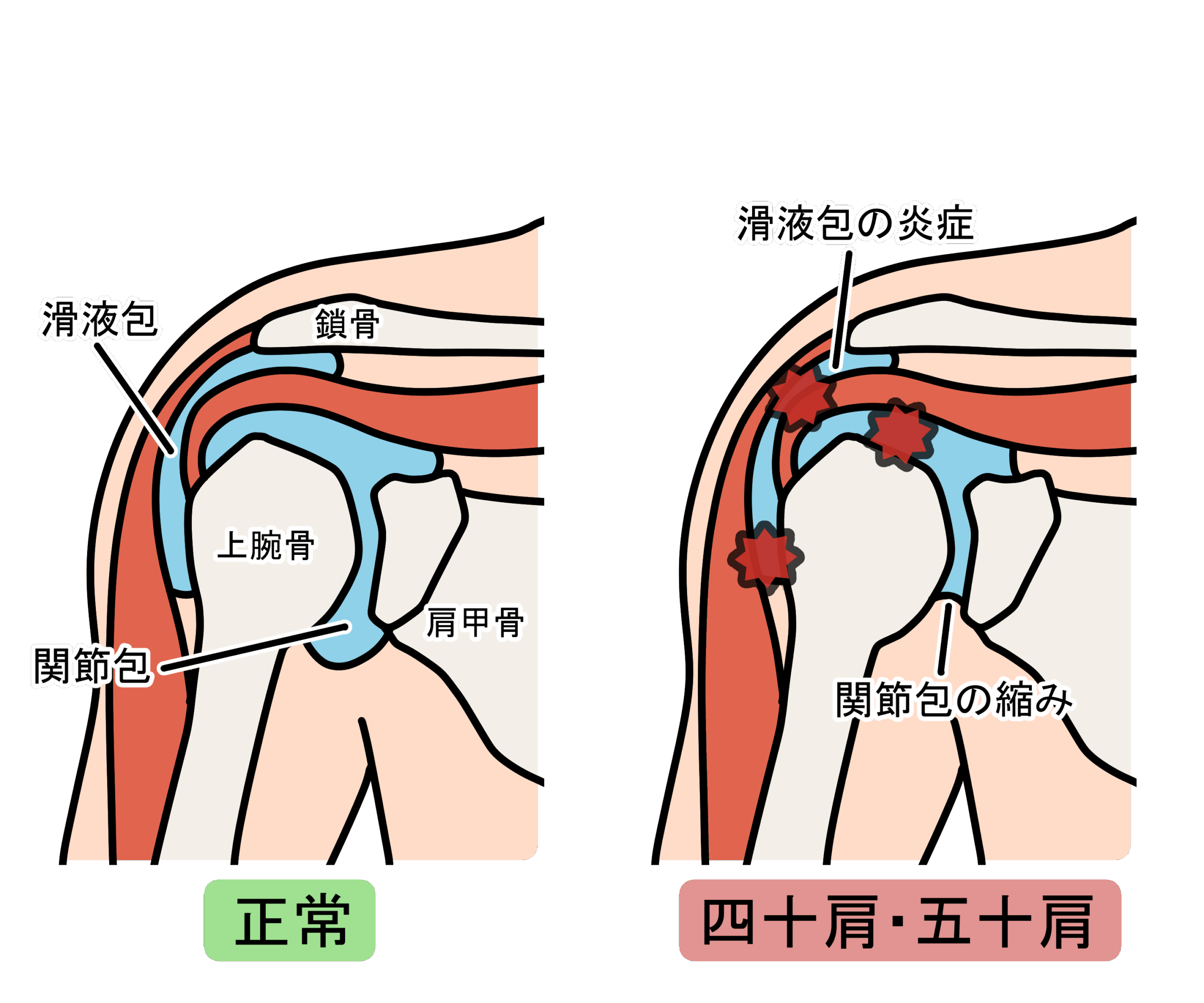 四十肩・五十肩のイラスト
