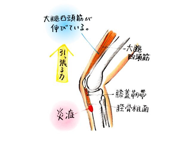 オスグット病